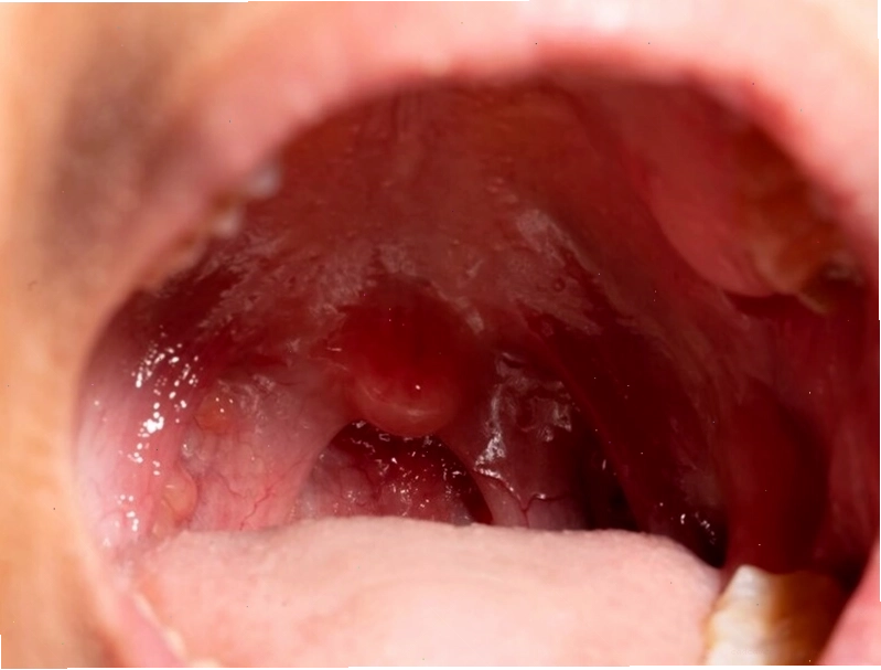 Amidan giúp ngăn chặn sự xâm nhập của vi khuẩn vào cơ thể