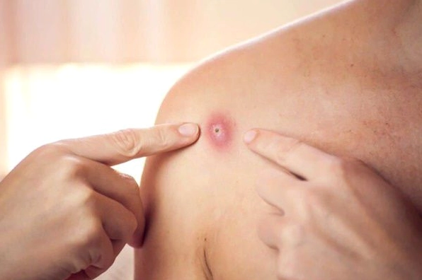 Bệnh đậu mùa khỉ: Nguyên nhân, triệu chứng, điều trị và phòng ngừa