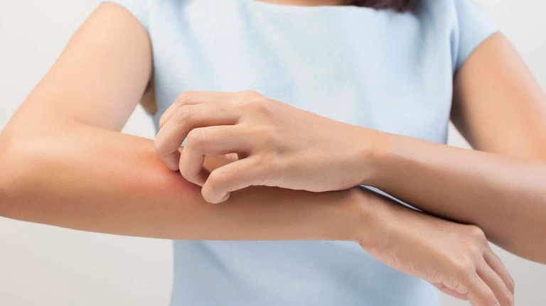 Bệnh ghẻ nước: Nguyên nhân, dấu hiệu nhận biết và cách điều trị hiệu quả