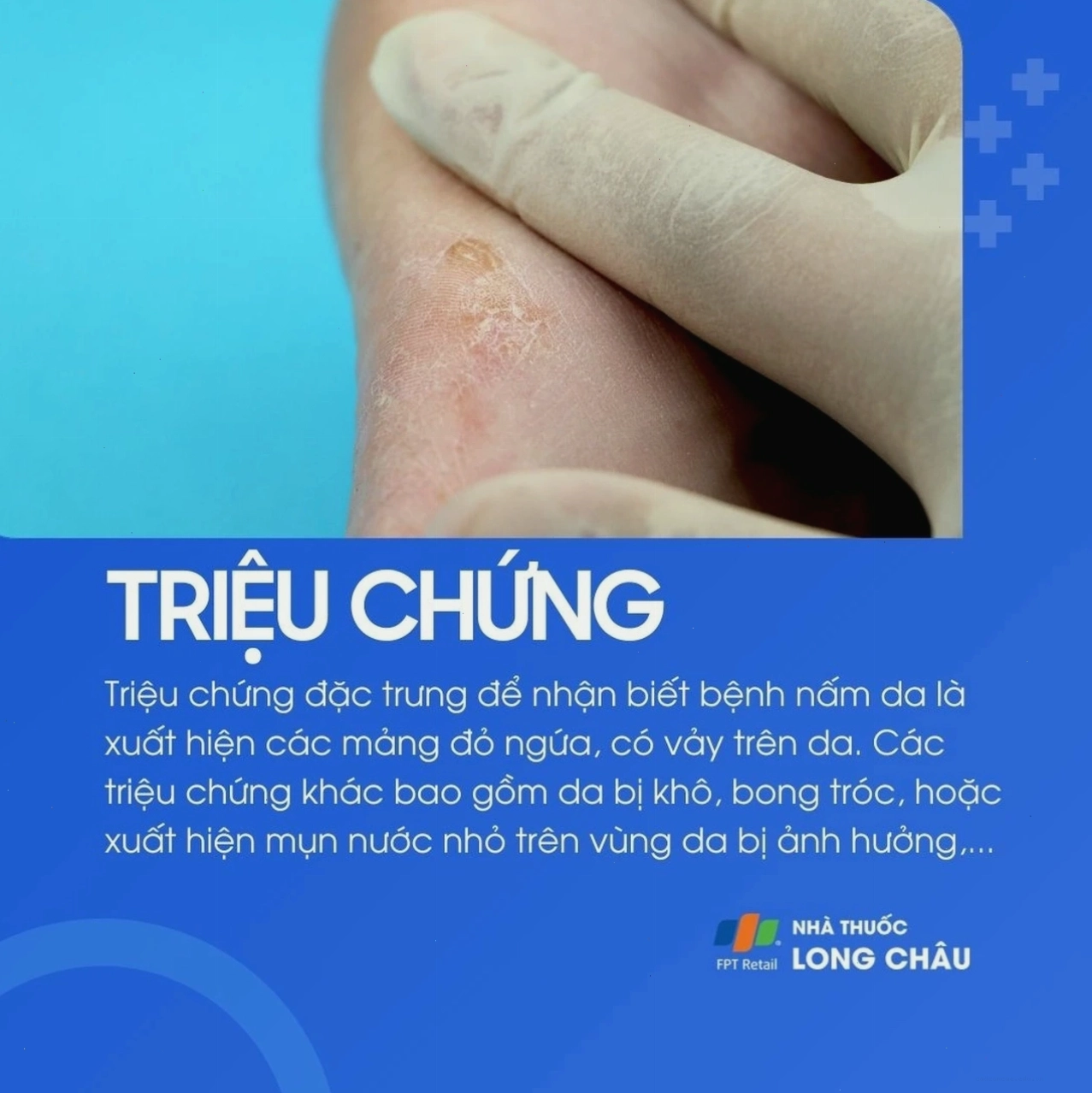 Bệnh nấm da thường gây mảng đỏ ngứa, có vảy, da khô, bong tróc hoặc nổi mụn nước nhỏ trên vùng da bị ảnh hưởng