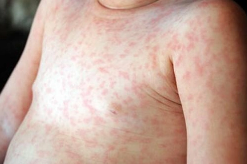 Bệnh Sởi: Dấu Hiệu, Nguyên Nhân và Cách Phòng Ngừa Hiệu Quả