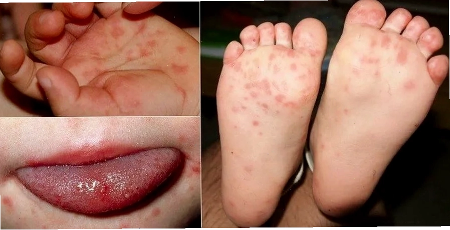 Bệnh tay chân miệng gây nổi bóng nước ở bàn tay, bàn chân, miệng, lưỡi trẻ