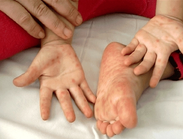 Bệnh Tay Chân Miệng: Những Điều Cần Biết Cho Phụ Huynh