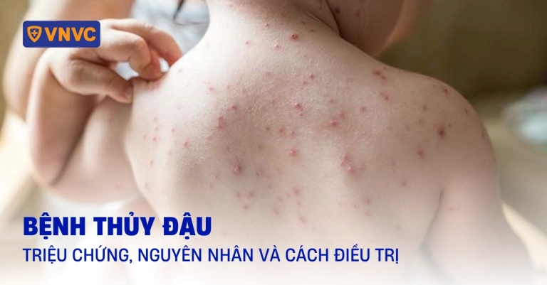 Bệnh Thủy Đậu Nguyên Nhân Triệu Chứng và Cách Phòng Ngừa Hiệu Quả