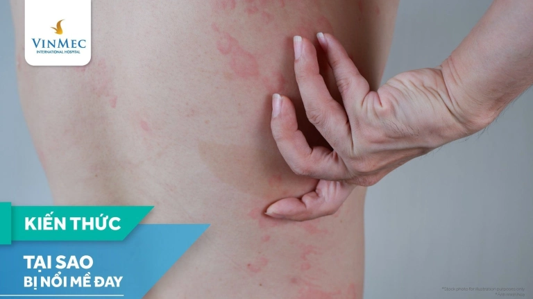 Bí ẩn đằng sau những cơn nổi mề đay: Nguyên nhân, triệu chứng và cách xử lý
