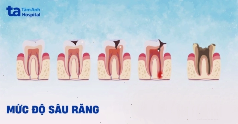 Biểu đồ minh họa 3 mức độ sâu răng và phương pháp xử lý tương ứng