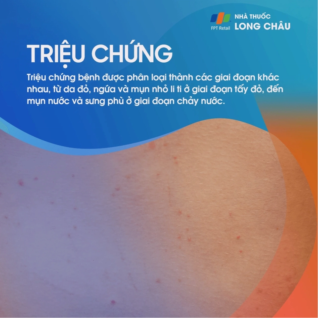 Các giai đoạn phát ban và chảy nước của viêm da cơ địa
