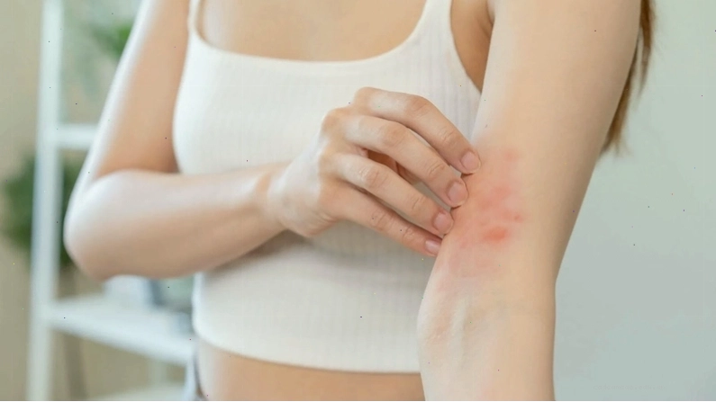Các loại thuốc bôi ngoài da giúp trị ngứa hiệu quả