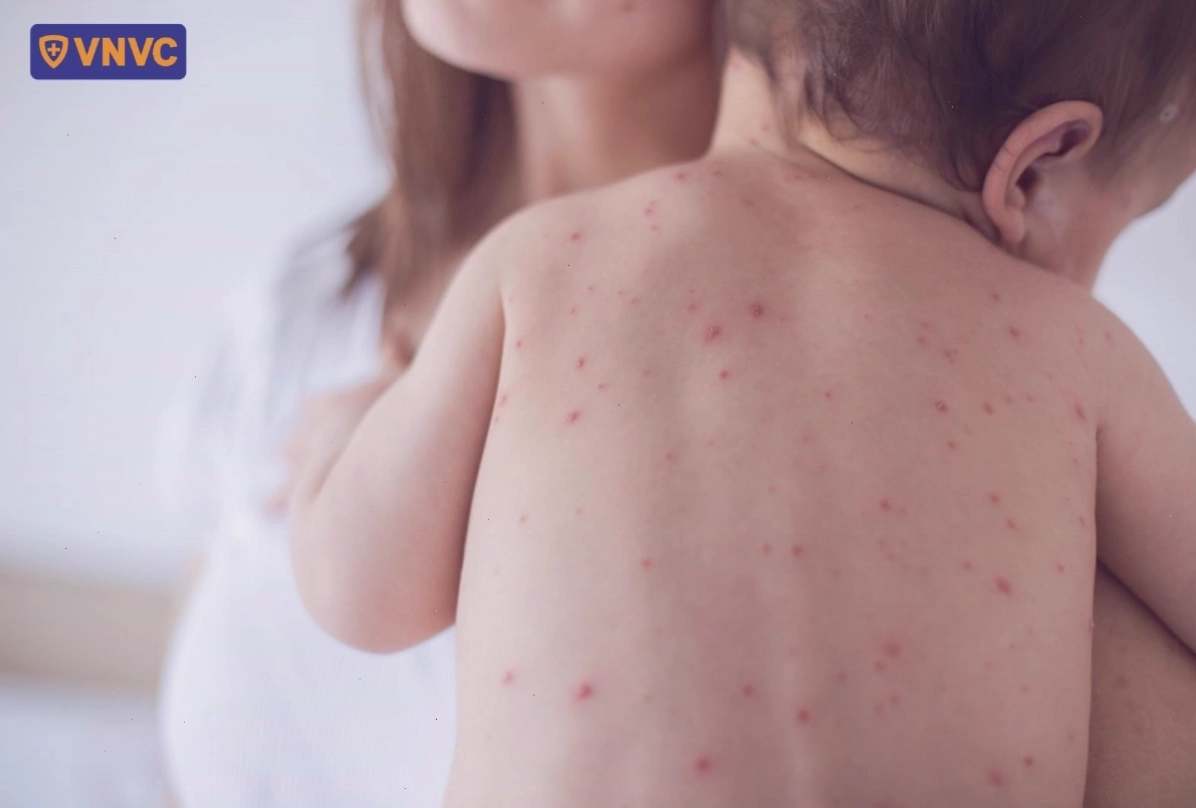 Các nốt mụn nước thủy đậu nổi dày đặc trên lưng trẻ