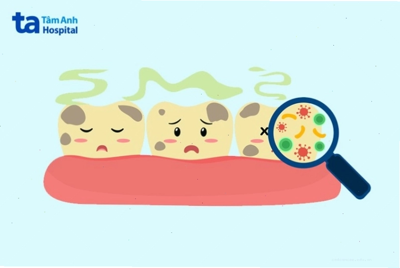 Các yếu tố dẫn đến sâu răng bao gồm vi khuẩn, chế độ ăn uống và vệ sinh răng miệng