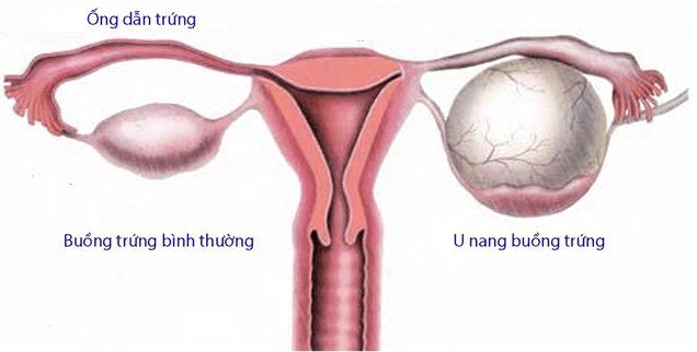 Dấu hiệu u nang buồng trứng lành tính và những điều cần biết