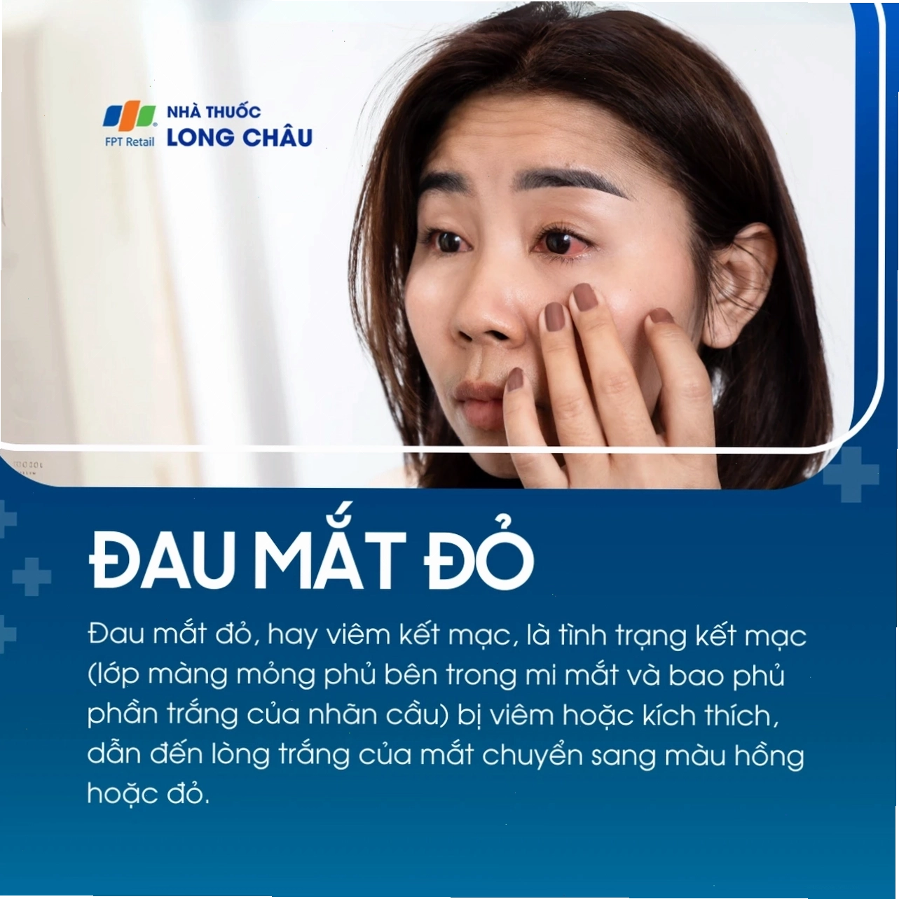 Đau mắt đỏ, viêm kết mạc khiến lòng trắng mắt chuyển màu đỏ