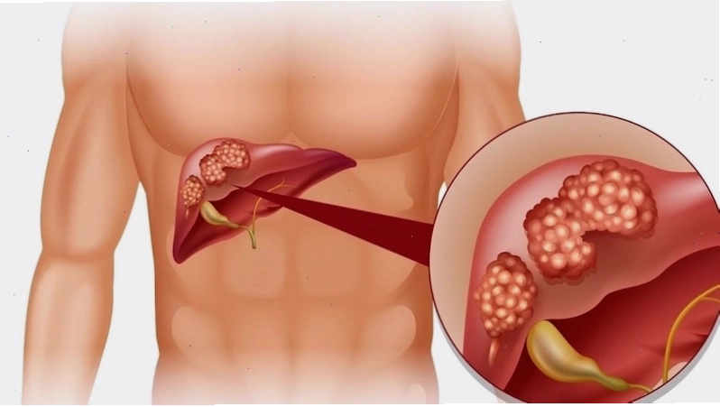 Để bảo vệ gan và duy trì chức năng gan cần thực hiện các biện pháp giải độc gan