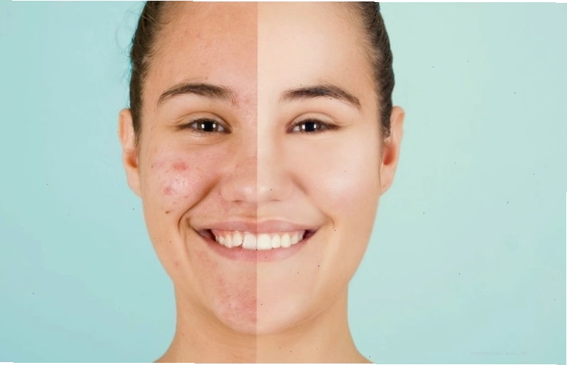 Điều trị mụn viêm theo chỉ định của bác sĩ