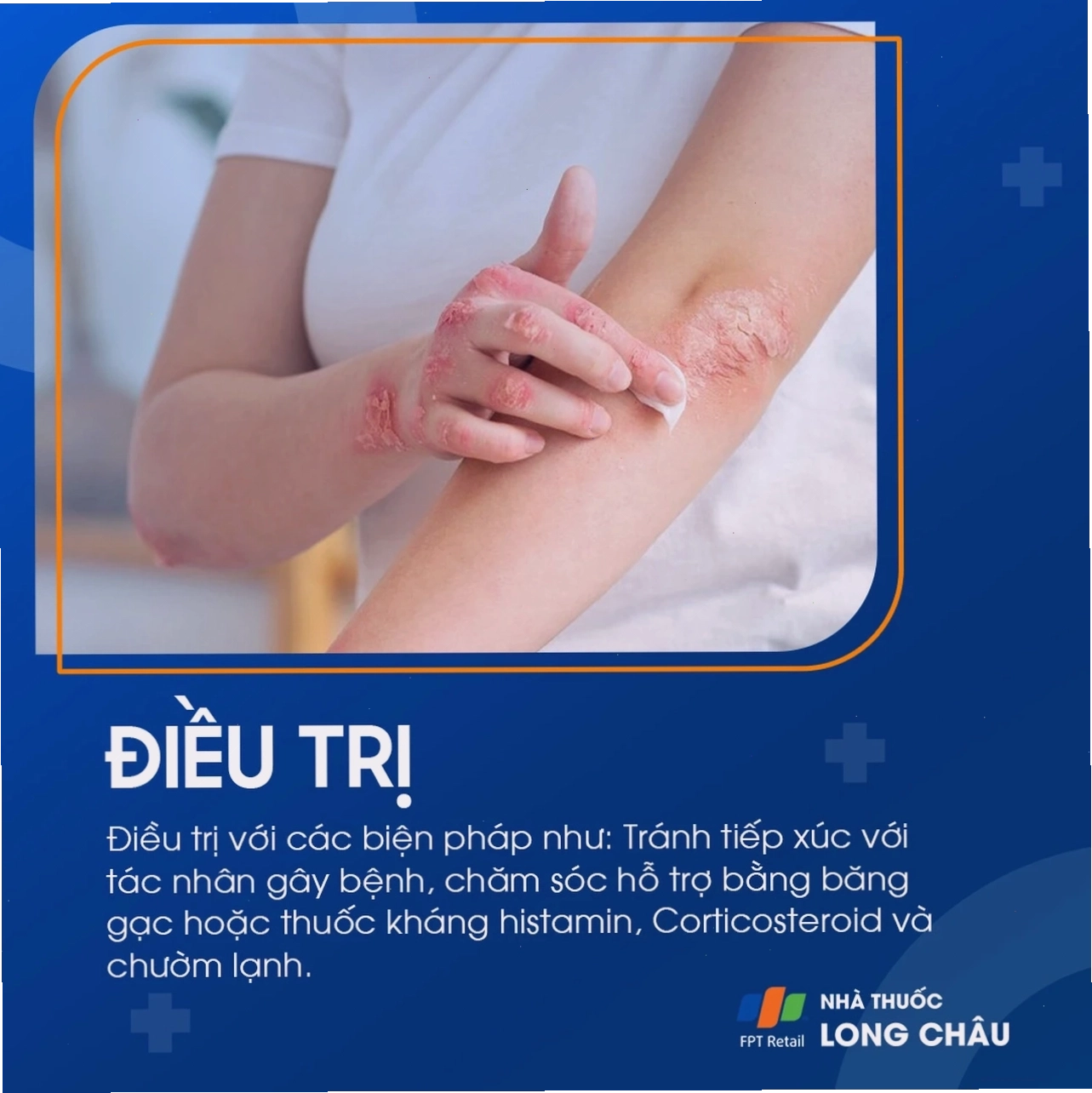 Điều trị viêm da do tiếp xúc bằng kem chống viêm và thuốc bôi giảm ngứa