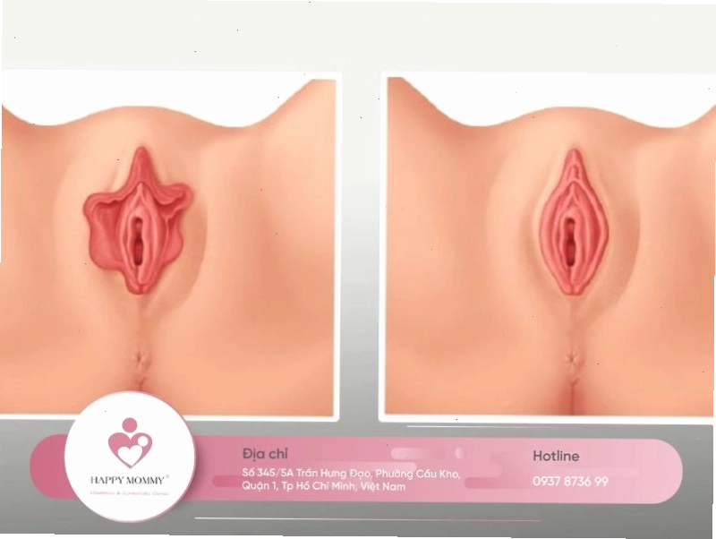 Giải thích lý do tại sao nên thẩm mỹ tạo hình cho môi bé