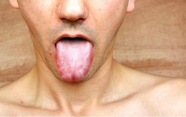 Giang mai có thể biểu hiện ở vùng miệng với các vết loét hoặc mảng trắng
