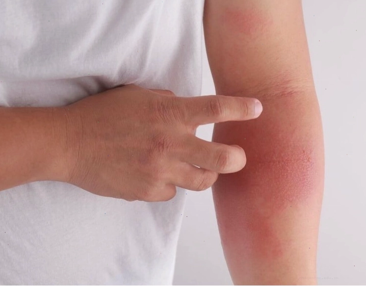Hình ảnh biểu hiện nhiễm giun sán, có thể cần dùng thuốc Albendazole điều trị