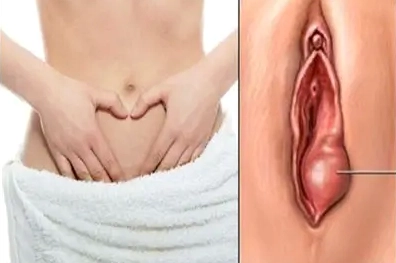 Hình ảnh cục thịt thừa ở vùng kín và các nguyên nhân cần biết