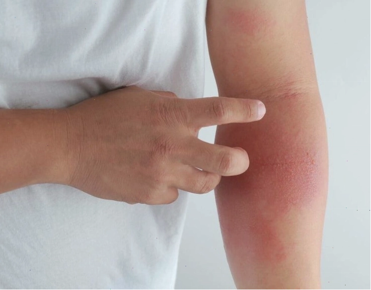 Hình ảnh minh họa các tác dụng phụ có thể gặp khi dùng thuốc
