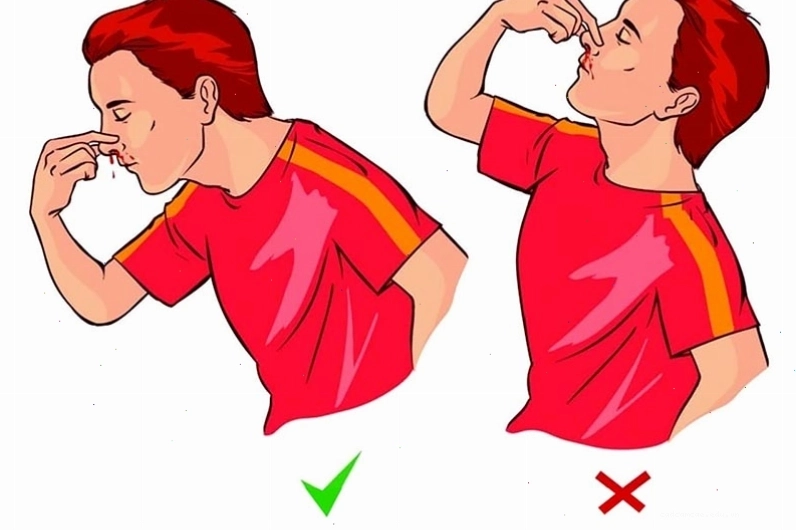 Hình ảnh minh họa cách sơ cứu khi bị chảy máu mũi
