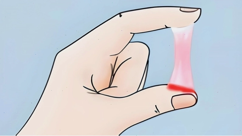 Hình ảnh minh họa tình trạng huyết trắng có lẫn sợi máu