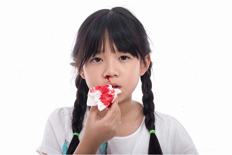Hình ảnh minh họa trẻ em bị chảy máu mũi