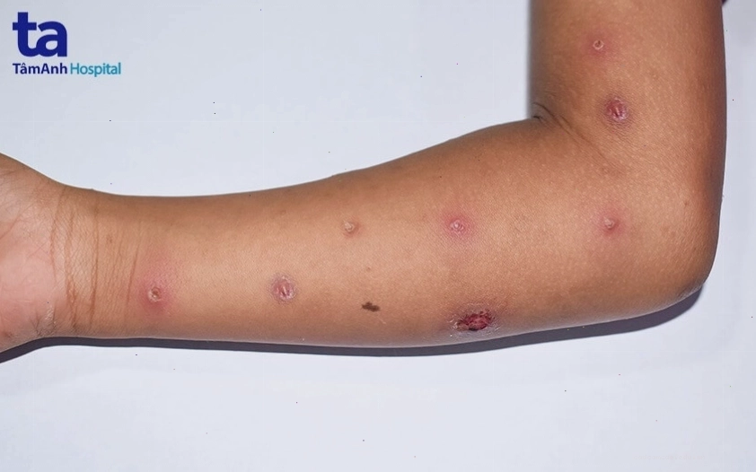 Hình ảnh minh họa virus gây bệnh đậu mùa khỉ
