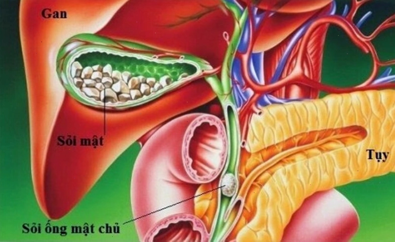 Hình ảnh sỏi mật, một nguyên nhân gây đau bụng trên rốn