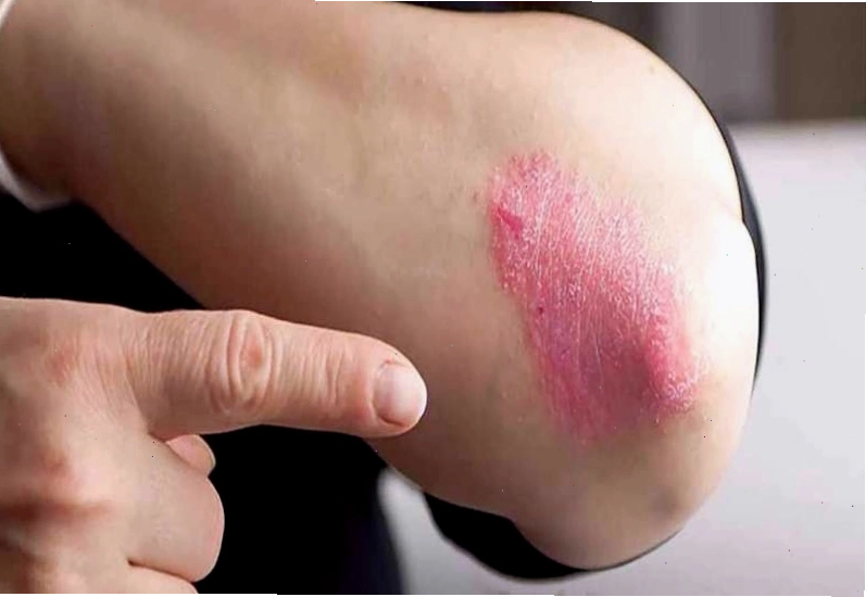 Hình ảnh vết hắc lào trên da