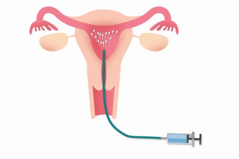 IUI là gì? Khám phá quy trình bơm tinh trùng vào buồng tử cung