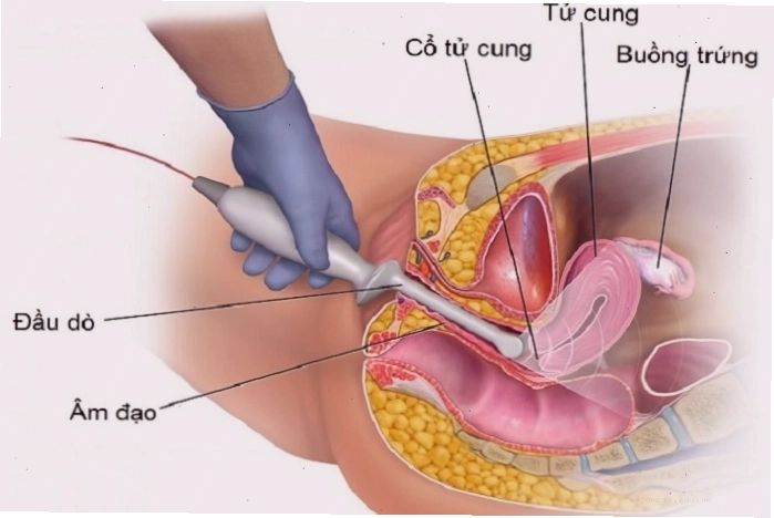 Kỹ thuật siêu âm đầu dò giúp chẩn đoán thai ngoài tử cung