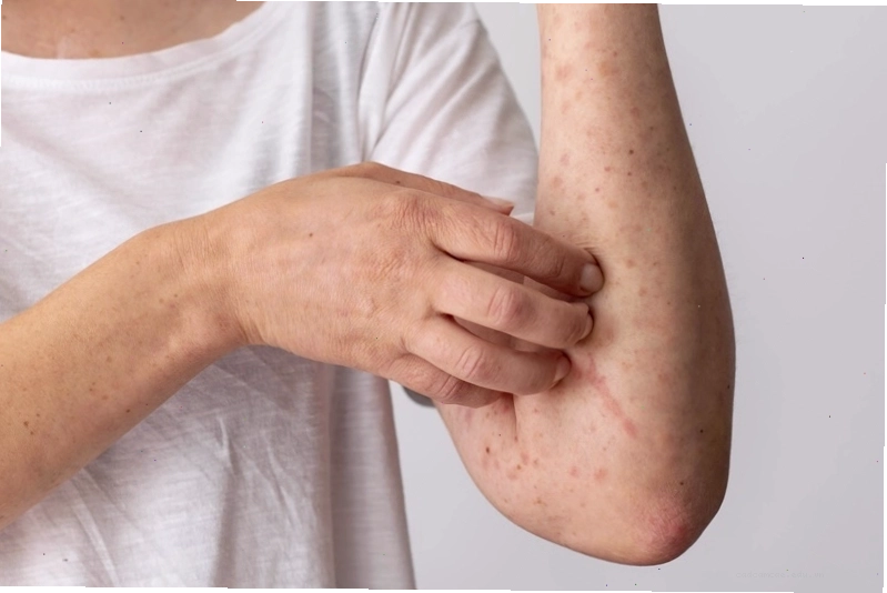 Lá bồ công anh có thể hỗ trợ điều trị các bệnh về da