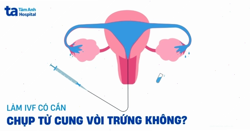 Làm IVF có cần chụp tử cung vòi trứng không?