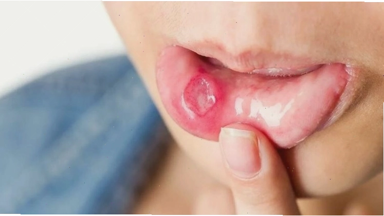 Mật ong giúp trị loét miệng