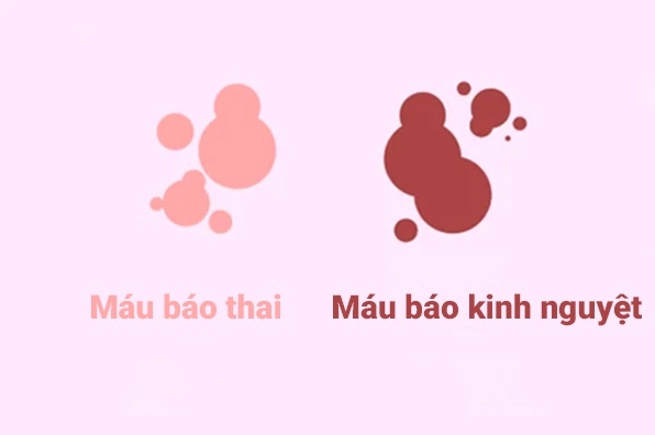 Máu báo thai hình thật, màu nâu nhạt và dạng như nào? Phân biệt chính xác