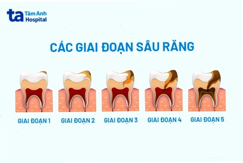 Minh họa các giai đoạn tiến triển của sâu răng từ nhẹ đến nặng