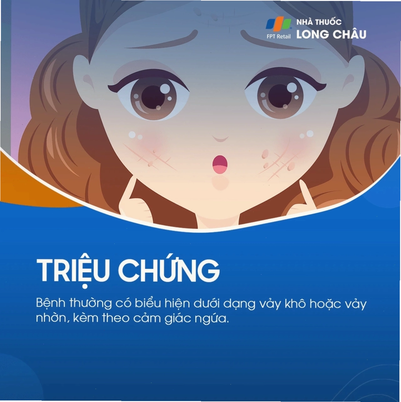 Minh họa các triệu chứng viêm da tiết bã với da đầu đỏ, nhờn và có vảy bong tróc