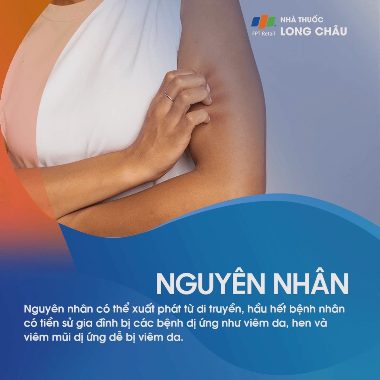 Minh họa nguyên nhân viêm da cơ địa liên quan đến di truyền và dị ứng