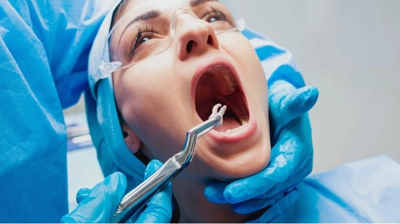 Minh họa tình trạng răng khôn cần được nhổ bỏ