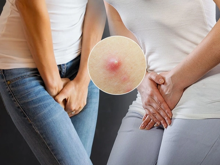 Mọc mụn ở vùng kín: Nguyên nhân, dấu hiệu và cách xử lý hiệu quả
