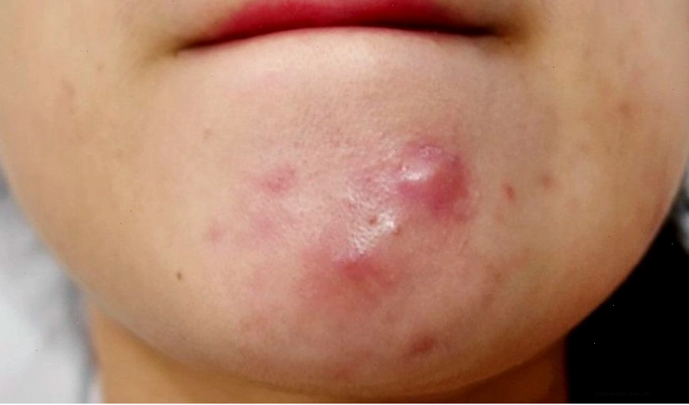 Mụn bọc là loại mụn có mủ, sưng to và gây đau nhức