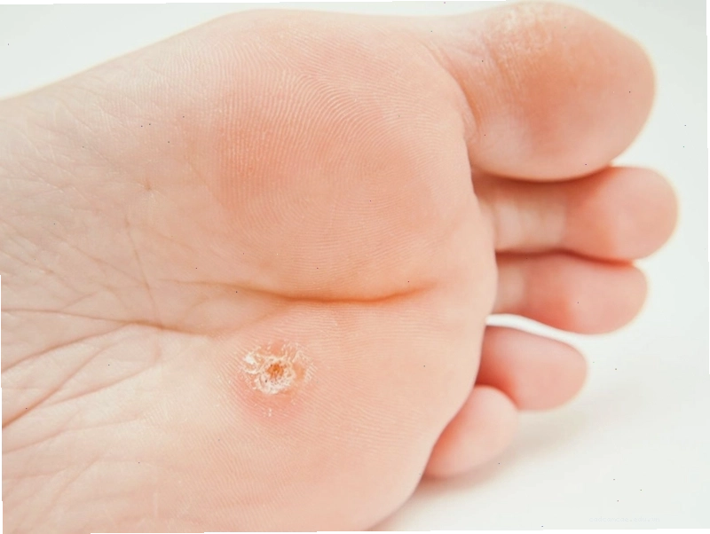 Mụn cóc ở lòng bàn chân gây khó khăn khi di chuyển