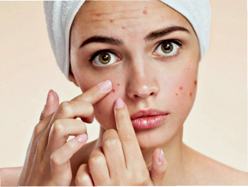 Mụn nang là dạng mụn viêm nặng, thường để lại sẹo