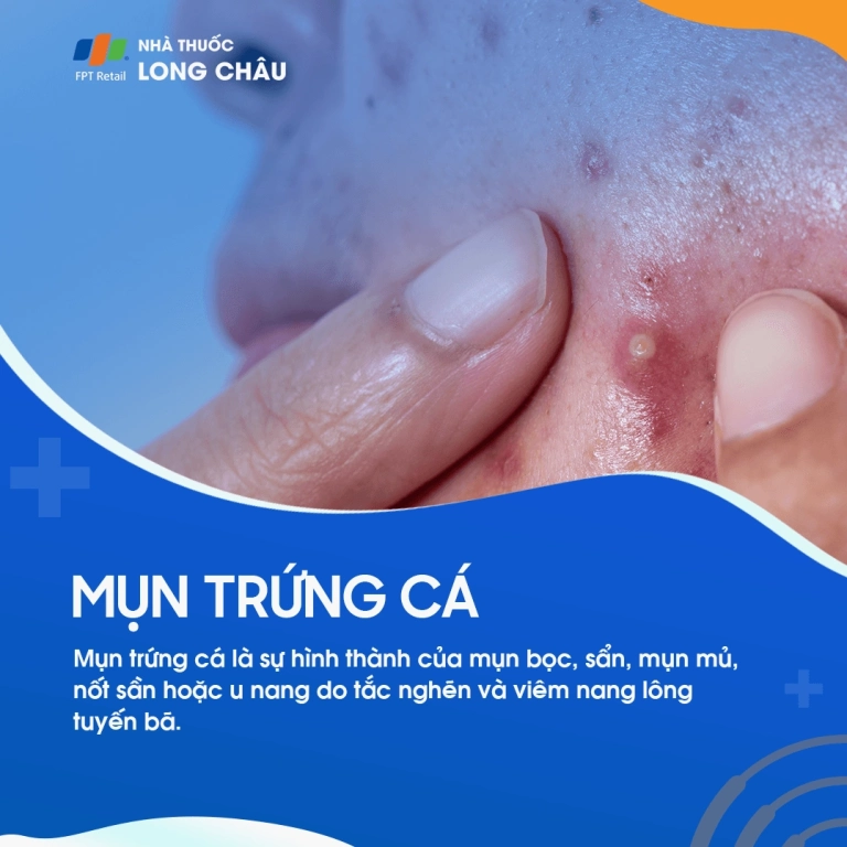 Mụn trứng cá: Nguyên nhân, triệu chứng và cách điều trị hiệu quả