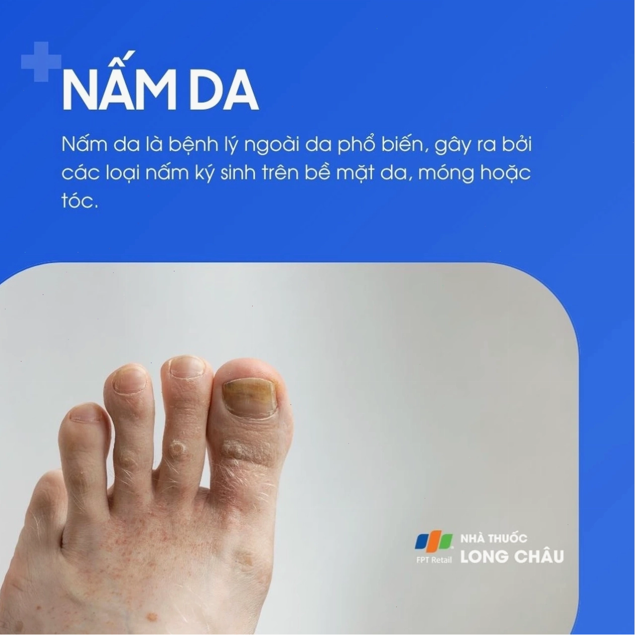 Nấm da là bệnh ngoài da phổ biến, do các loại nấm ký sinh gây ra trên bề mặt da, móng hoặc tóc