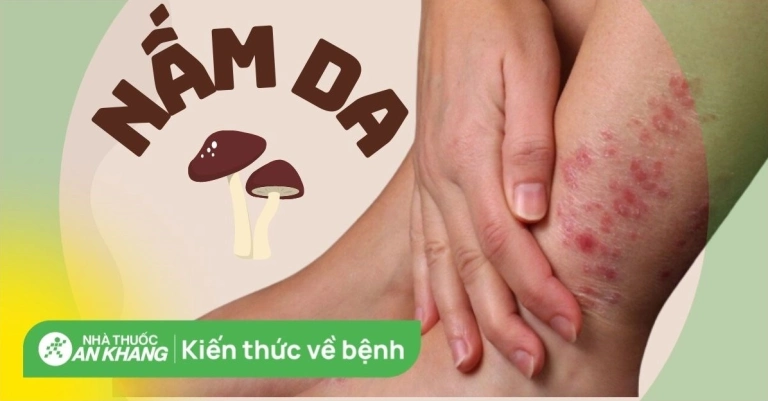 Nấm da: Nguyên nhân, dấu hiệu và cách điều trị hiệu quả tại Nhà Thuốc Long Châu
