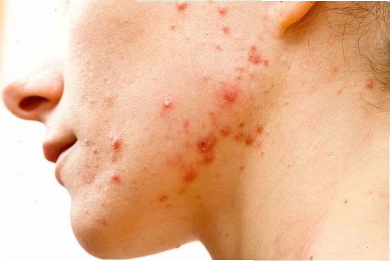 Nặn mụn bọc sai cách có thể gây mụn lan rộng