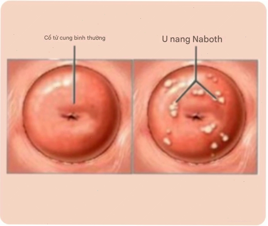 Nang Naboth là tổn thương lành tính, thường gặp ở phụ nữ trong độ tuổi sinh sản