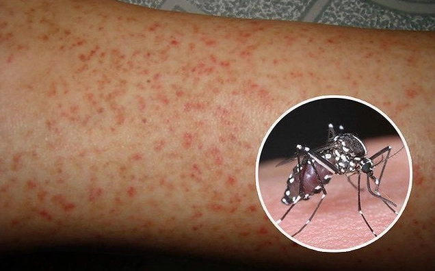 Nhận biết nhanh triệu chứng sốt xuất huyết và cách xử lý hiệu quả